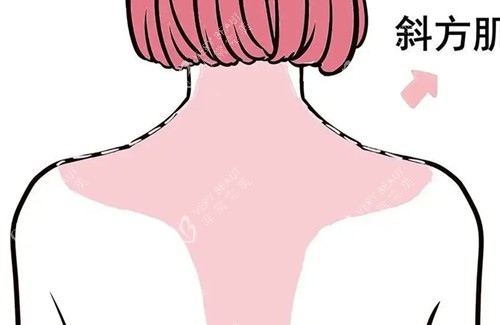 背部吸脂卡通示意图 背部吸脂卡通示意图