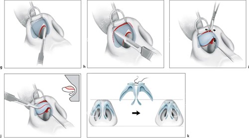 鼻头缩小手术过程图