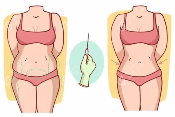 吸脂填充术 吸脂填充术