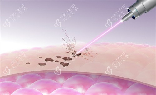 激光祛斑原理图