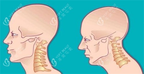 脖子长出富贵包卡通照片图