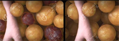 美国既塑3D溶脂前后脂肪细胞变化 美国既塑3D溶脂前后脂肪细胞变化