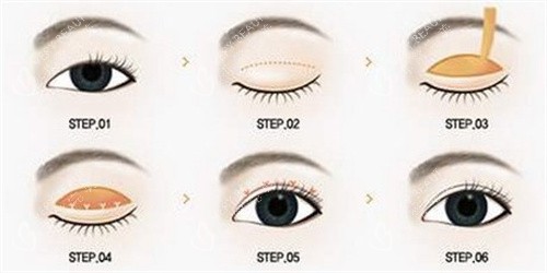 全切双眼皮怎么做的 全切双眼皮怎么做的