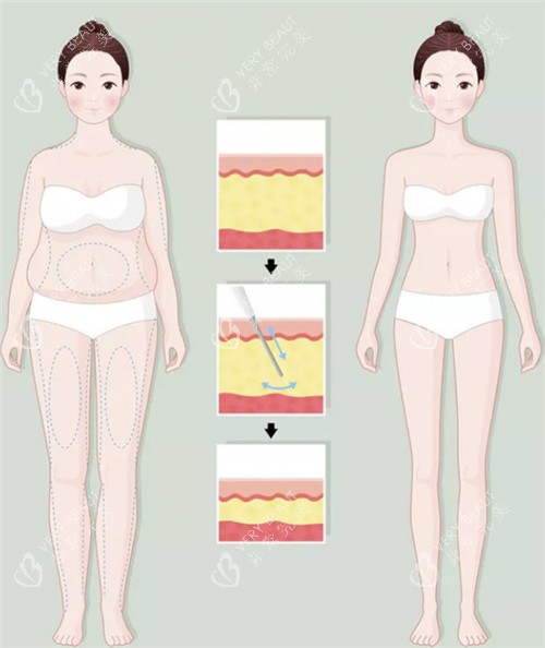 吸脂前后动画图示 吸脂前后动画图示