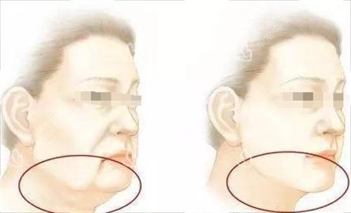 微拉美面部提升动画前后对比图