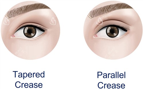 双眼皮加宽手术前后对比图