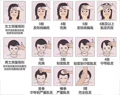 发际线测量规范 发际线测量规范