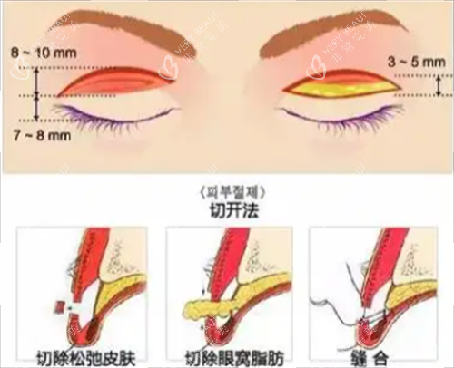 切开双眼皮手术 切开双眼皮手术