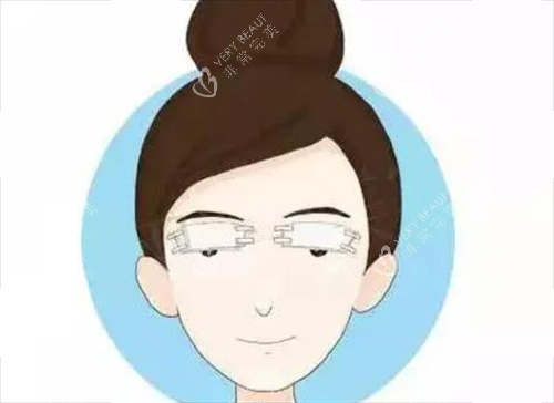 双眼皮术后
