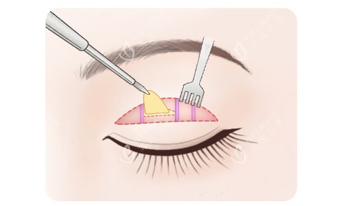 全切双眼皮脂肪切除