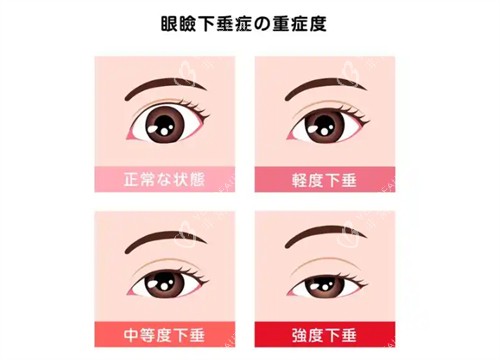 上睑下垂不同程度的样子