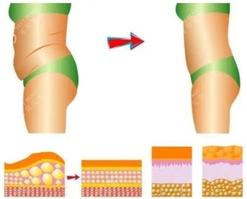 吸脂过程前后示意图