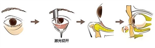 激光祛眼袋过程