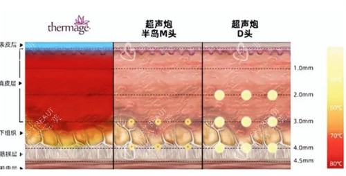 超声炮治疗深度对比 超声炮治疗深度对比