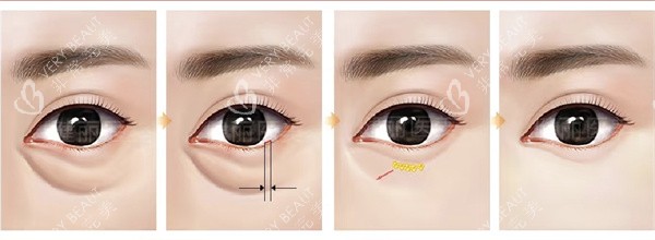 不开刀祛眼袋 不开刀祛眼袋