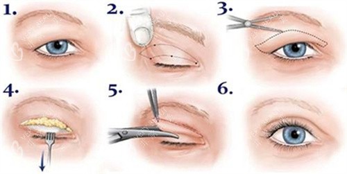 双眼皮全切术过程图 双眼皮全切术过程图