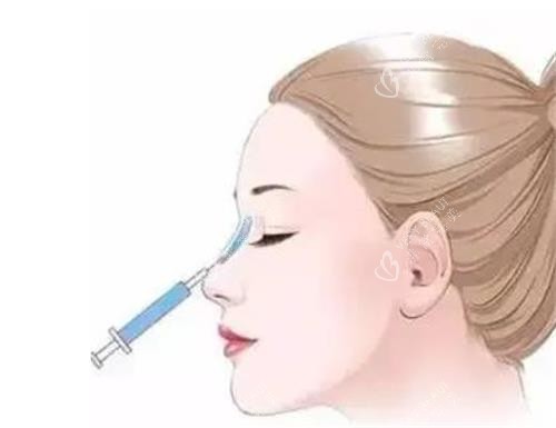 液态隆鼻的部位