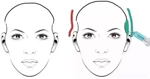 太阳穴凹陷玻尿酸注射对比动画图 太阳穴凹陷玻尿酸注射对比动画图