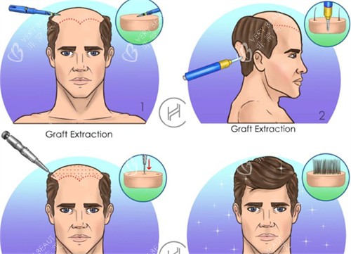 脂溢性脱发植发前后对比图