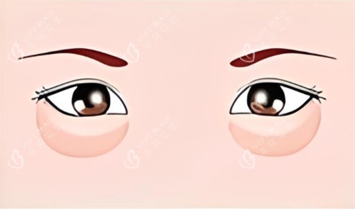 眼袋的示意图