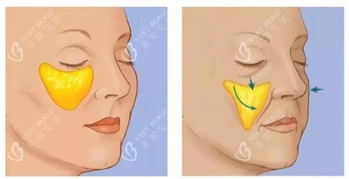 苹果肌下垂演示动画图