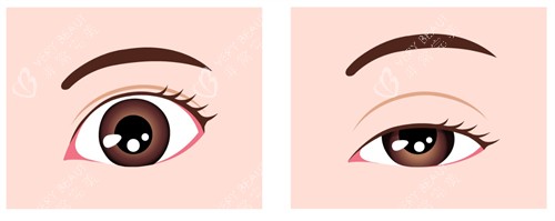 上睑下垂的样子图解