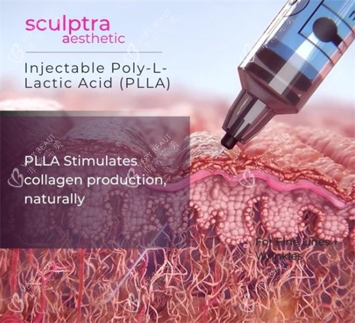 塑妍萃注射深度