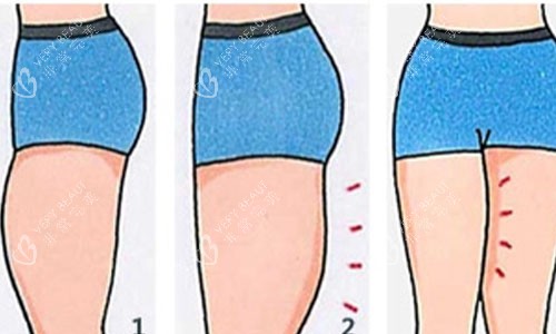 吸脂前后对比动画图 吸脂前后对比动画图