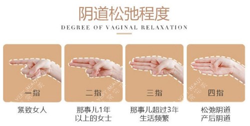 阴道松弛程度图示