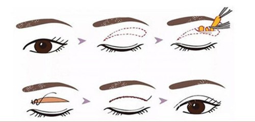 全切双眼皮过程示意图 全切双眼皮过程示意图