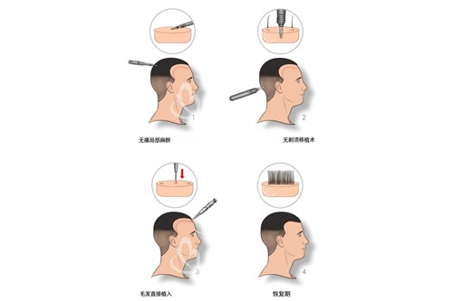 不剃发植发示意图 不剃发植发示意图