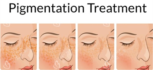 激光祛斑前后皮肤对比 激光祛斑前后皮肤对比