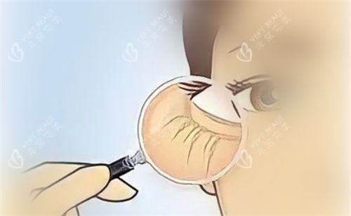 眼部细纹放大展示图.jpg