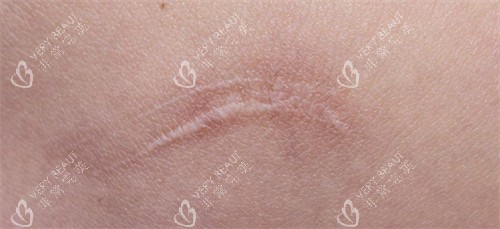 增生的疤痕 增生的疤痕