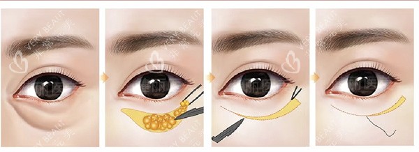 外切祛眼袋 外切祛眼袋