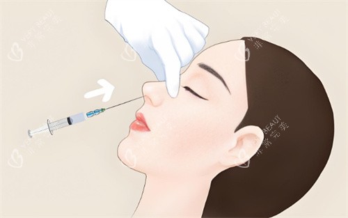 注射隆鼻 注射隆鼻