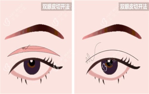 全切双眼皮手术的切口部位