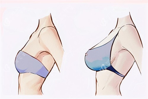 假体隆胸的前后对比图