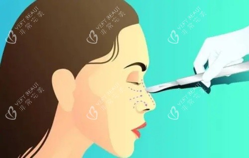 隆鼻失败修复示意图