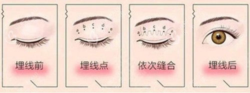 埋线双眼皮过程示意图片