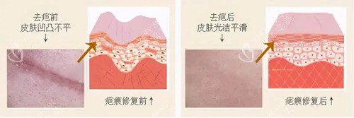 激光祛疤卡通示意图