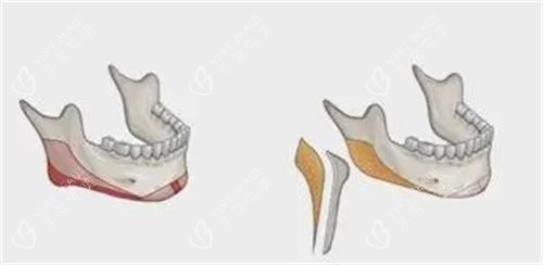 削骨磨骨示意图 削骨磨骨示意图