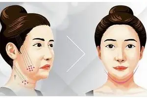 面部提升术