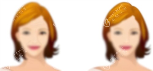 热玛吉前后对比