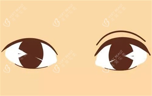 双眼皮手术的前后对比