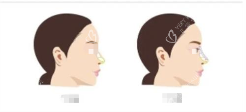 隆鼻前后对比示意图