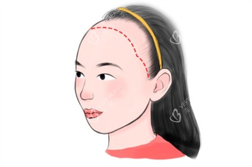 女型发际线种植卡通 女型发际线种植卡通