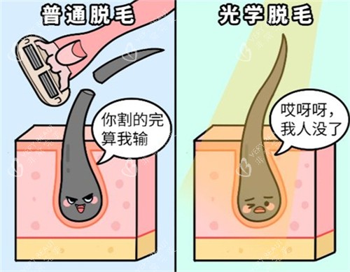 激光脱毛和普通刮毛的区别