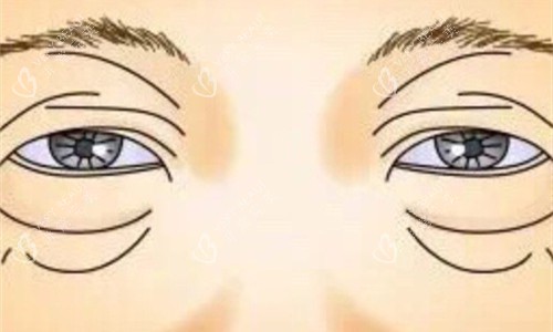 眼袋展示卡通图