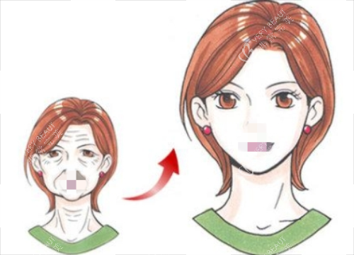 除皱前后对比图 除皱前后对比图